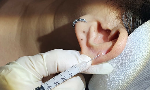 Piercing Keloids: Causes, Symptoms, and Prevention