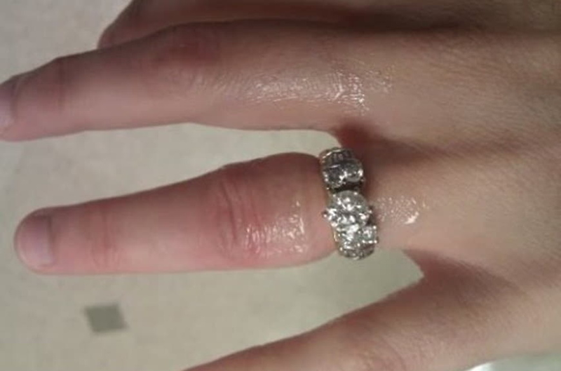 Wearing a ring causes swollen hands: Causes, consequences, and remedies